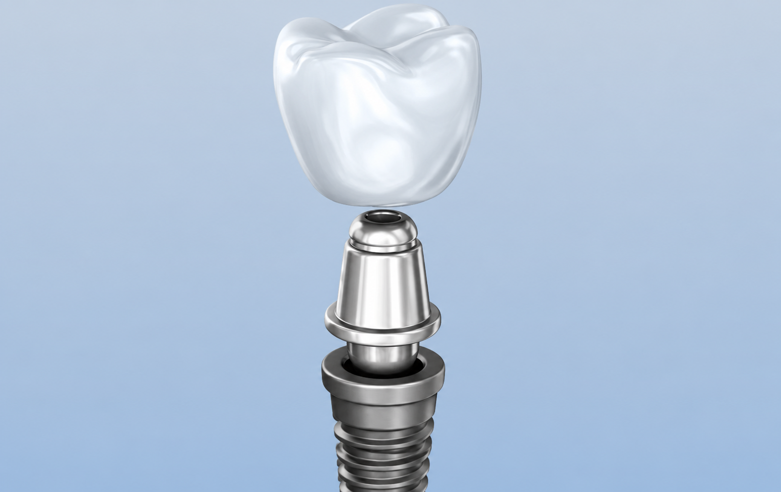 Ilustração 3D de implante dentário — tratamento oferecido pela FF Odonto